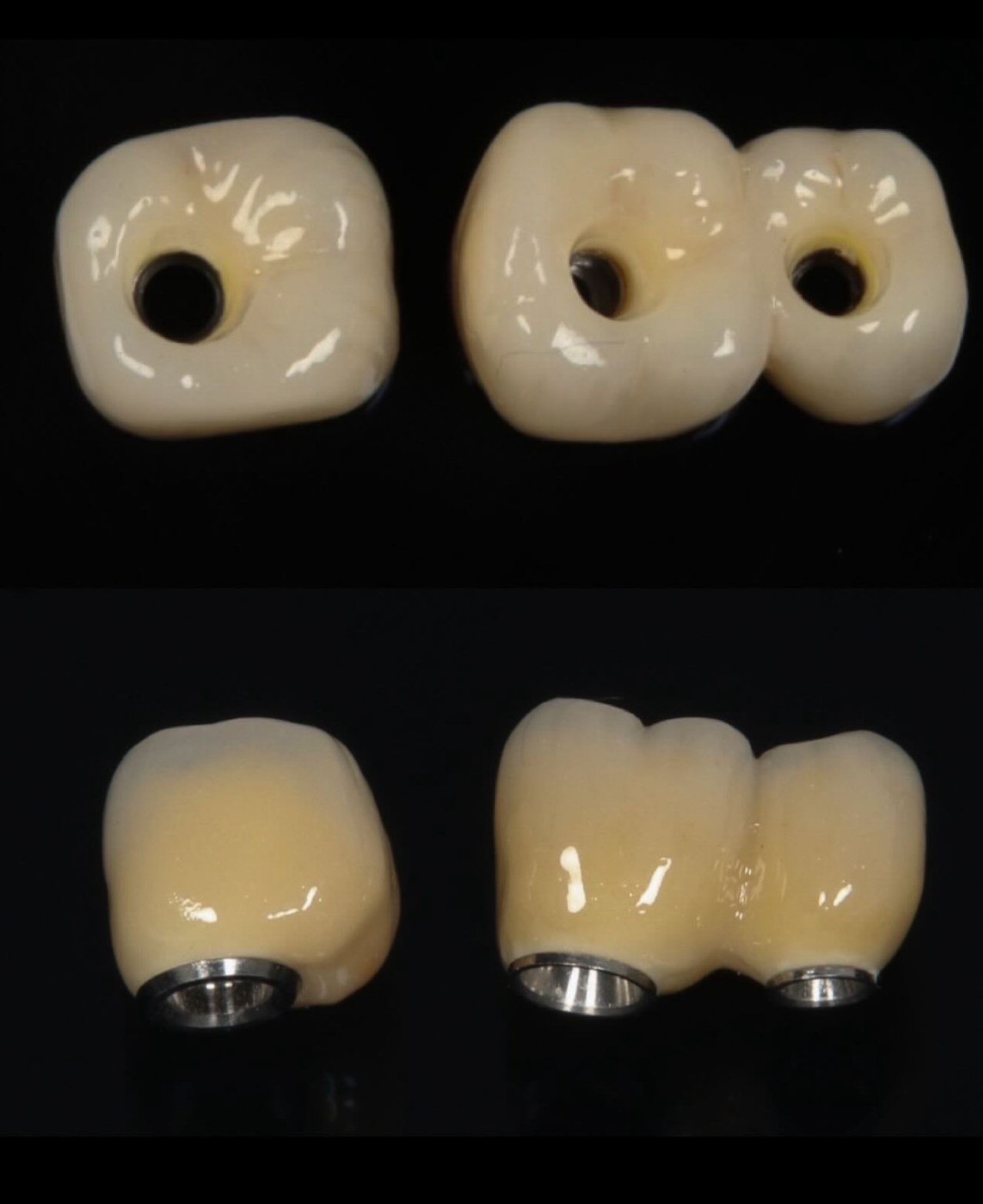 Prótesis sobre implantes - Caso 7